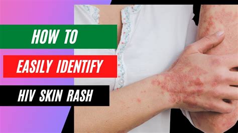 How To Identify An Hiv Rash Youtube