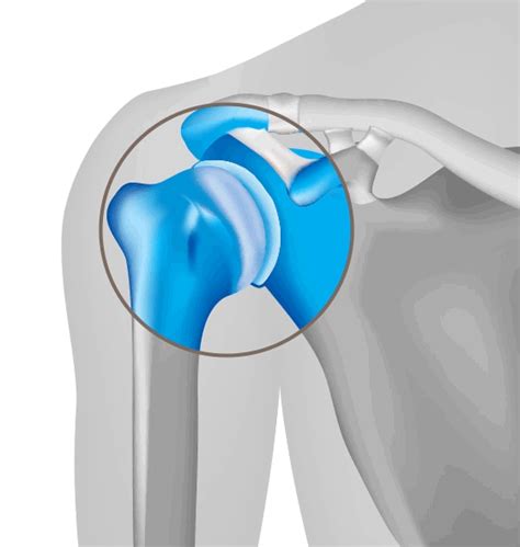 What To Know About Shoulder Arthritis Orthobridge Orthopaedic Institute