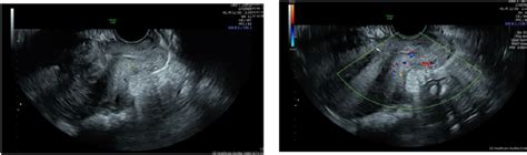 A Aspect Of The Cervix In Transvaginal Ultrasonography Showing