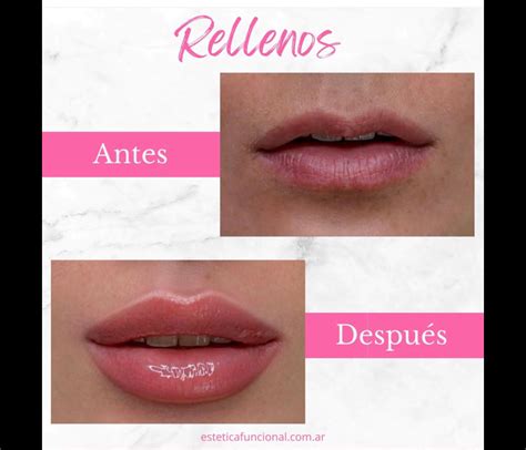 Relleno De Labios Con Cido Hialur Nico Est Tica Funcional