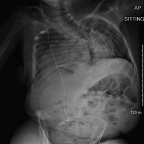 Posterior Anterior Plain Radiograph Performed Before Index Surgery For Download Scientific