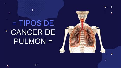 Presentación Sobre Cancer De Pulmonpptx