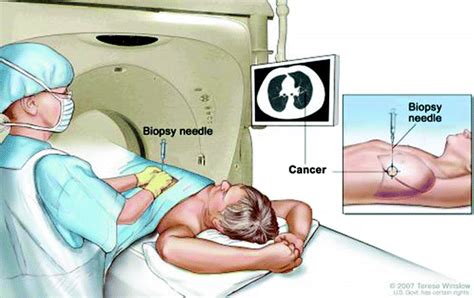 Review On Image Guided Lung Biopsy Springerlink