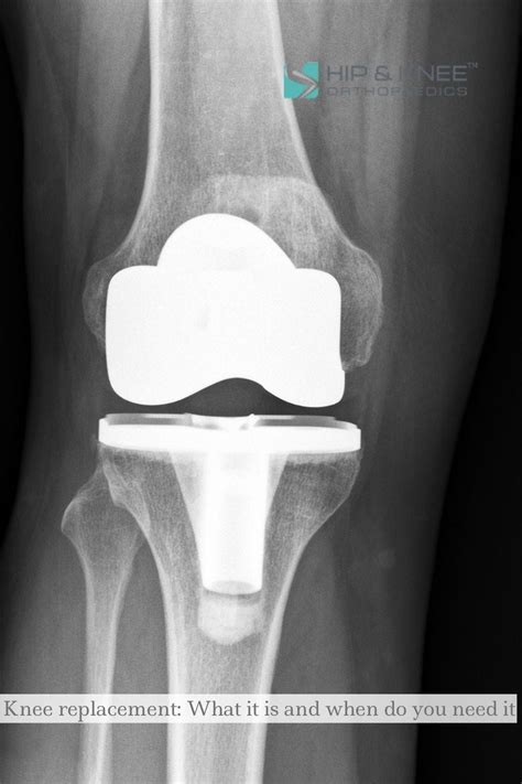 Knee Replacement What It Is And When Do You Need It By Hip And Knee Orthopaedics Medium