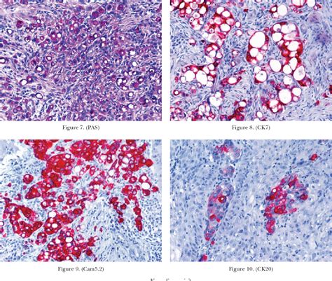 Figure From Signet Ring Cell Gastric Adenocarcinoma Metastasizing