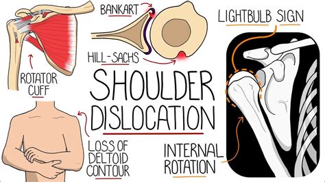 Shoulder Dislocation Explained Clearly Glenohumeral Joint Dislocation 8280 Hot Sex Picture