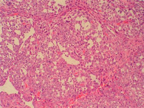 Solitary Fibrous Tumor Of The Thigh With Epithelioid Features A Case