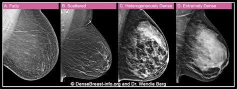 Your Top Questions Answered | DenseBreast-info, Inc.