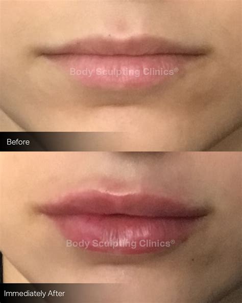 Can Lip Filler Look Natural Body Sculpting Clinics