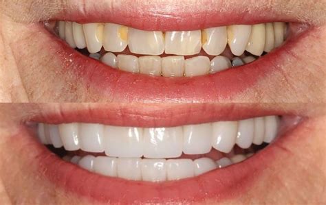 Full Mouth Reconstruction Scottsdale Az Sonoran Dental Design