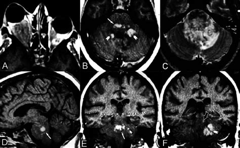 Post Contrast Axial T1 Weighted Magnetic Resonance Imaging Mri