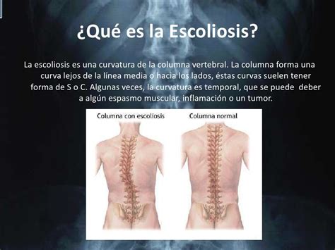 Escoliosis