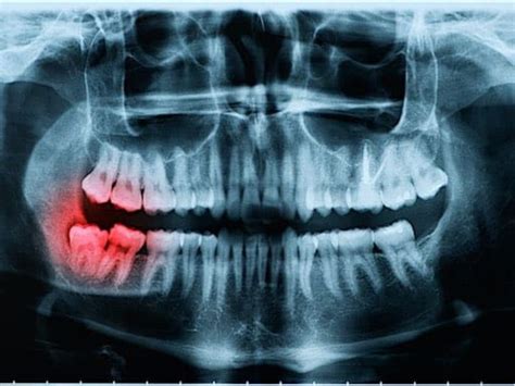 Impacted Wisdom Teeth