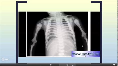 Erlenmeyer Flask Deformity