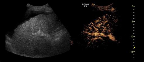 Left: the grey-scale ultrasound shows a coarsened liver echotexture ...