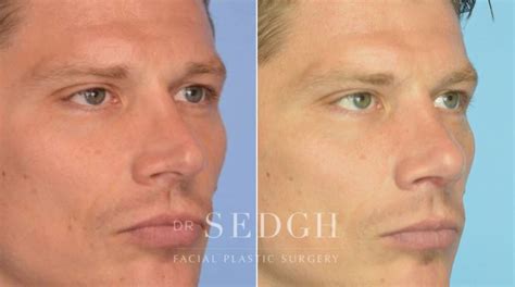 Crooked Nose Surgery Before After Photos Dr Sedgh