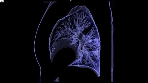 COVID-19 pneumonia – Chest X-ray or CT? - Siemens Healthineers