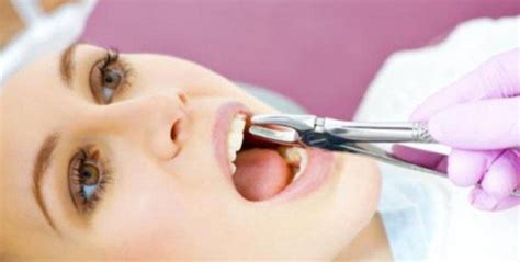 Cuidados Que Debemos Realizar Después De Una Extracción Dental Cds Clínica Dental Solé