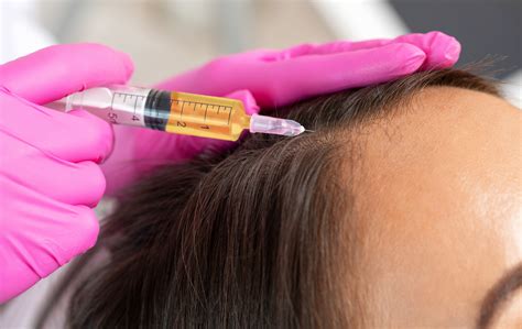 Platelet Rich Plasma PRP For Treating Hair Loss