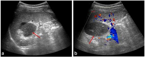 Medicina Free Full Text Radiologic Findings Of Single Accessory