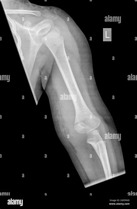 Supracondylar Fracture In The Humerus Of A Year Old Female Patient