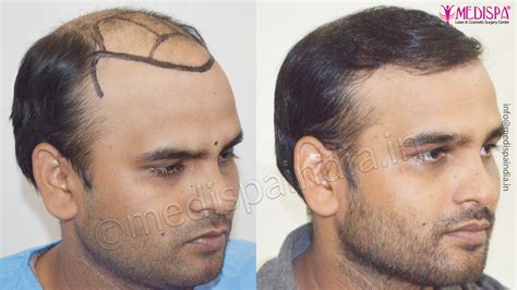 Fut Hair Transplant Results In Ahmedabad Medispa India