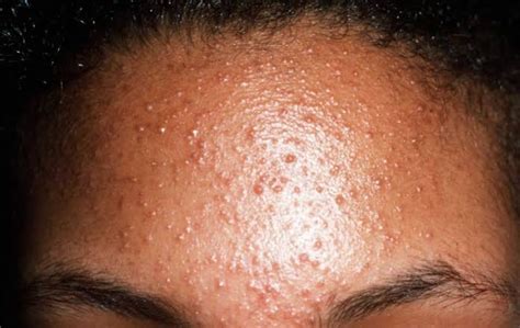 Malassezia Folliculitis Malassezia Folliculitis Commonly Known… By Victoria Essentials Medium