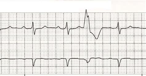 Float Nurse Ekg Rhythm Strips 69