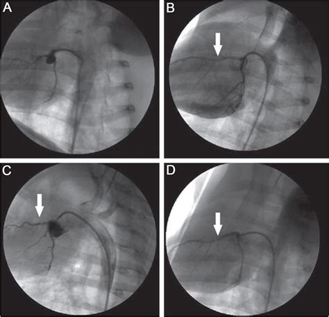 Coronary artery angiogram after left anterior descending (LAD) artery ...