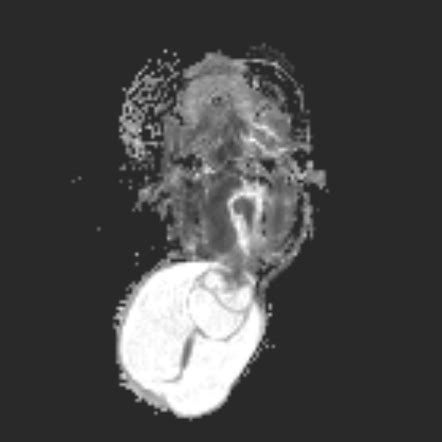 Chiari Iii Malformation With Occipital Encephalocele Image