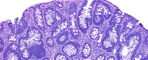 Gastrointestinal/Liver Pathology