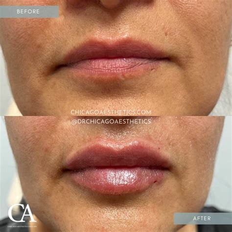 Lip Fillers Before And After Photos Chicago Aesthetics