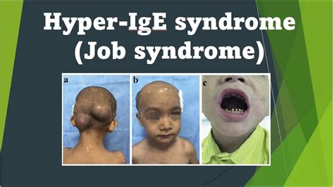 Hyper Ige Syndrome Job S Syndrome Immunodeficiency Disorder | The Best ...