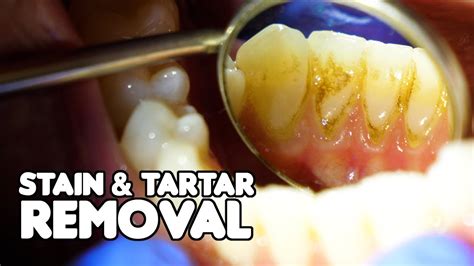 Dental Cleaning Explained Stain And Tartar Removal Youtube