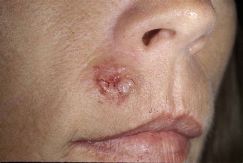 Basal Cell Carcinoma Treatment | Skin Cancer Solutions in LA