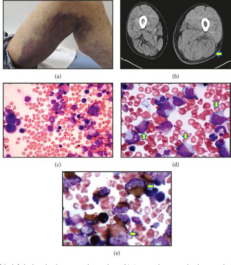 Figure 2 From A Case Of Acquired Haemophilia A In A Patient With