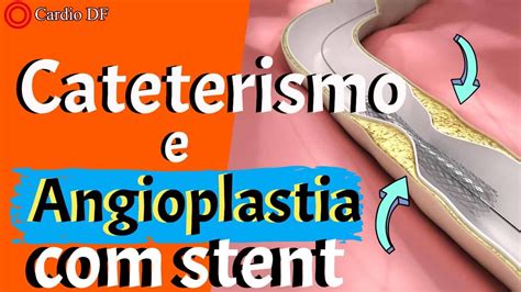 Angioplastia Coronariana e Colocação de Stents Tire suas dúvidas