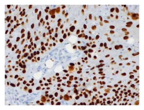 P Immunostain Shows Positive Nuclear Staining In Tumor Cells A