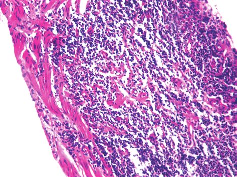 Hematoxylin And Eosin H And E Stained Image Showing Sheets Of Cells