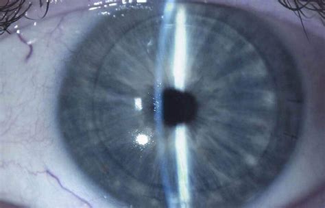 Corneal Transplant Before And After