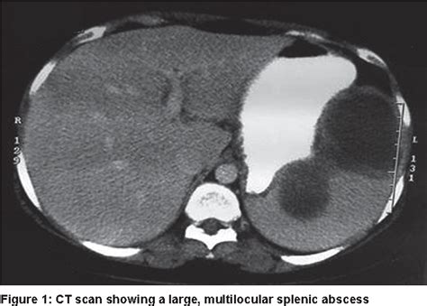 Figure 1 From Laparoscopic Splenectomy For Tuberculous Abscess Of The