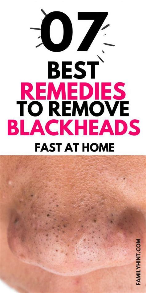 Why am i getting these tiny black moles on my face – Artofit