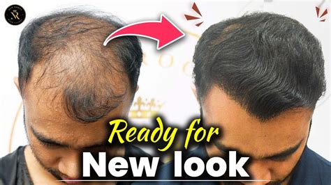 Sapphire Hair Transplant Results In Advanced Grade Baldness Youtube