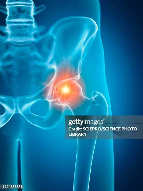 Hip Pain Anatomy Photos and Premium High Res Pictures - Getty Images