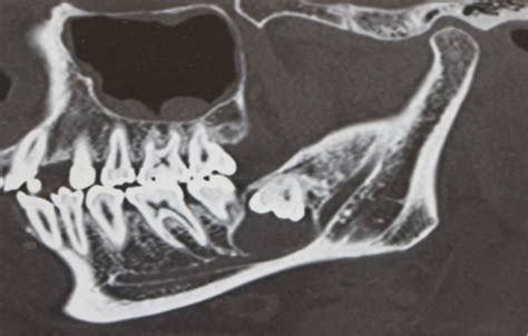 Pathological Fracture Mandible