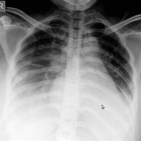 Pneumonia Chest X Ray Diagnosis