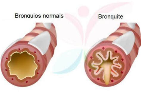 Bronquite Asm Tica Sintomas E Cuidados