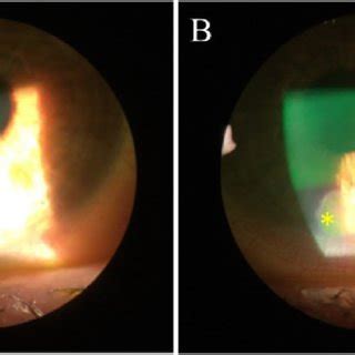 Resolved nummular keratitis on slit lamp of right eye(A) and left eye ...