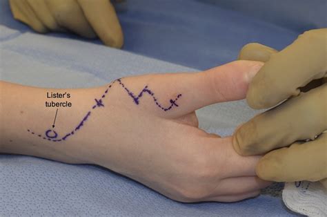 Snapping Extensor Pollicis Longus Tendon Subluxation Seconda Jbjs