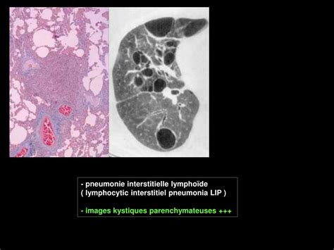 Ppt Le Syst Me Lymphatique Du Parenchyme Pulmonaire Et Sa Pathologie